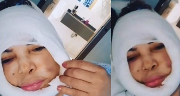 فيديو فلّة الجزائرية قبل حذفه.. إنتفاخ في وجهها وشفتيها داخل المستشفى!