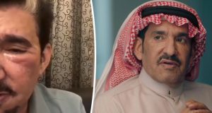 فيديو – عبدالله السدحان يتعرض لإصابة بالغة في الوجه